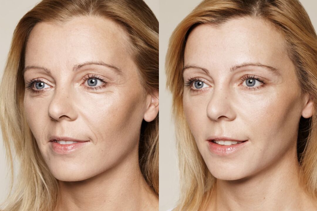 Valeria intenskin facial cream before and after experience